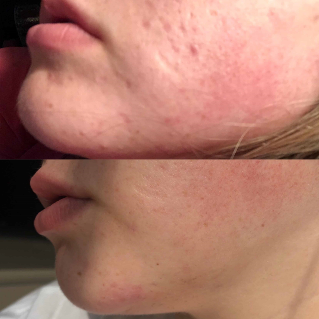 azelaic acid before and after 